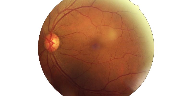 What Is Neovascular Age-Related Macular Degeneration: An Understanding