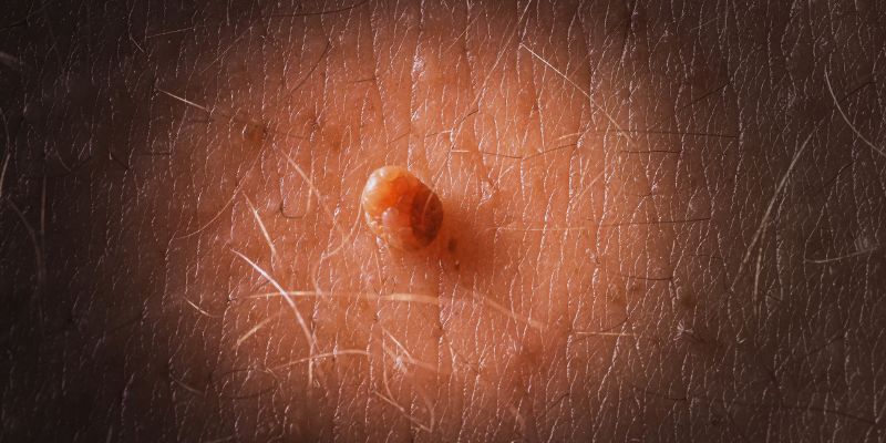 What's the Link Between Skin Tags and Diabetes: An Understanding  