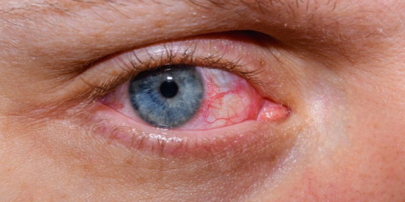 How to Treat Dry Eye Disease: Get the Effective Remedies for Relief 