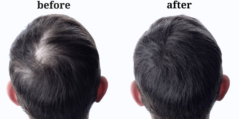 Power of Quick Hair Transplant: Speedy Results Without Compromising Quality