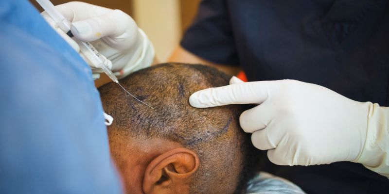 What to Expect Before, During, and After a Hair Transplant: An Understanding